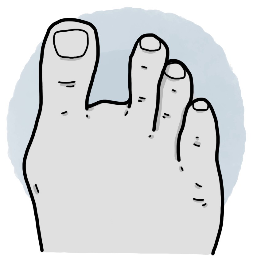 Second toe amputation