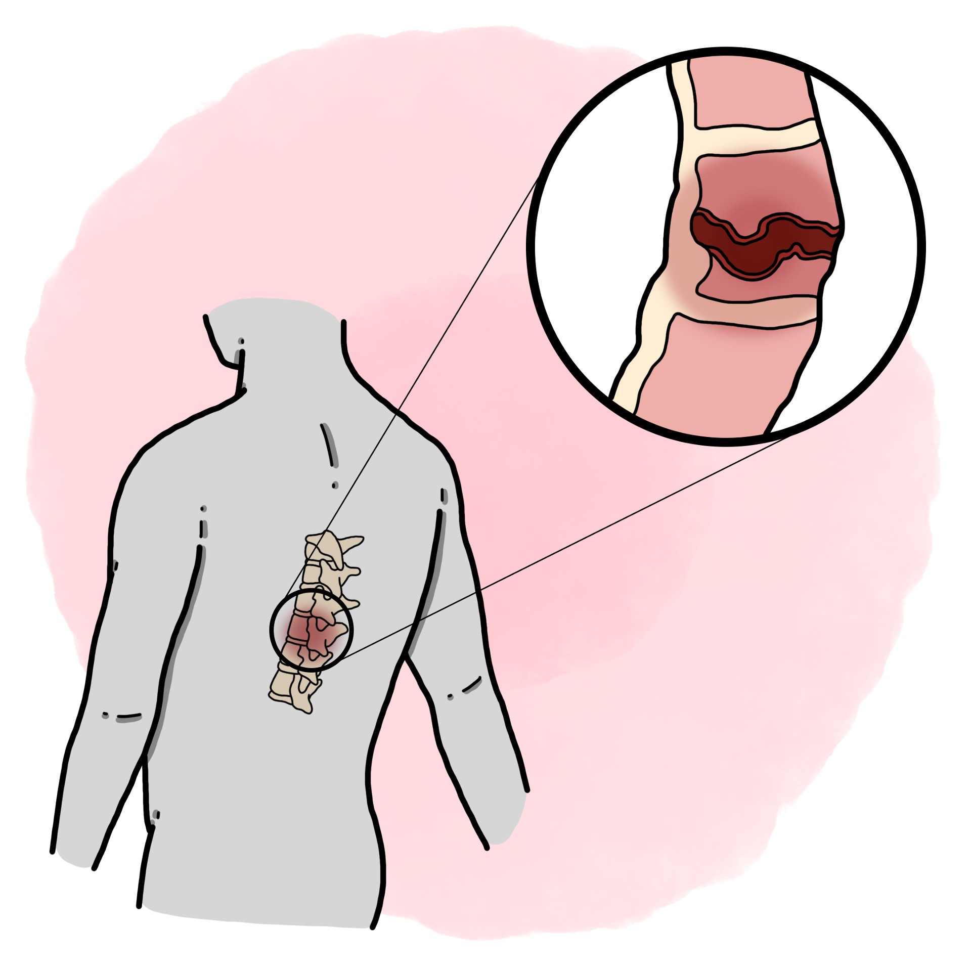 Vertebral osteomyelitis
