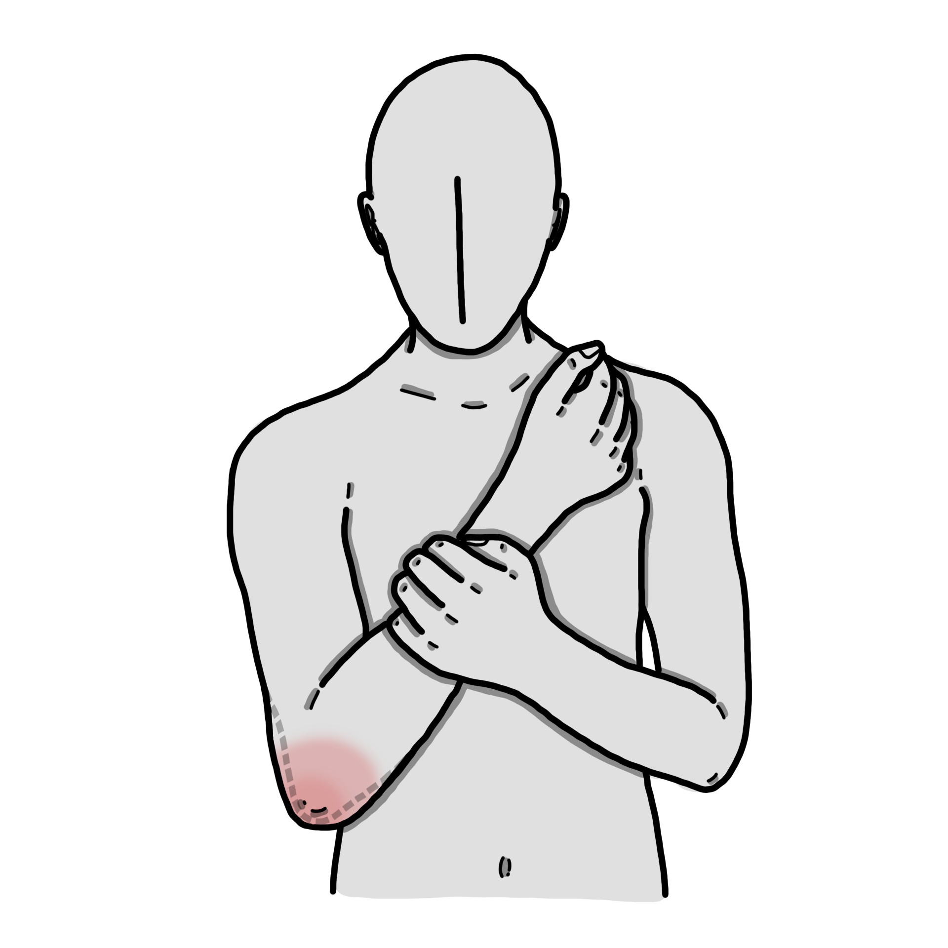 Geschwollener Ellenbogen