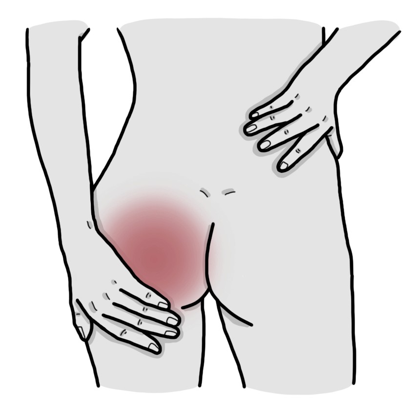 Schmerzen im Gesäß