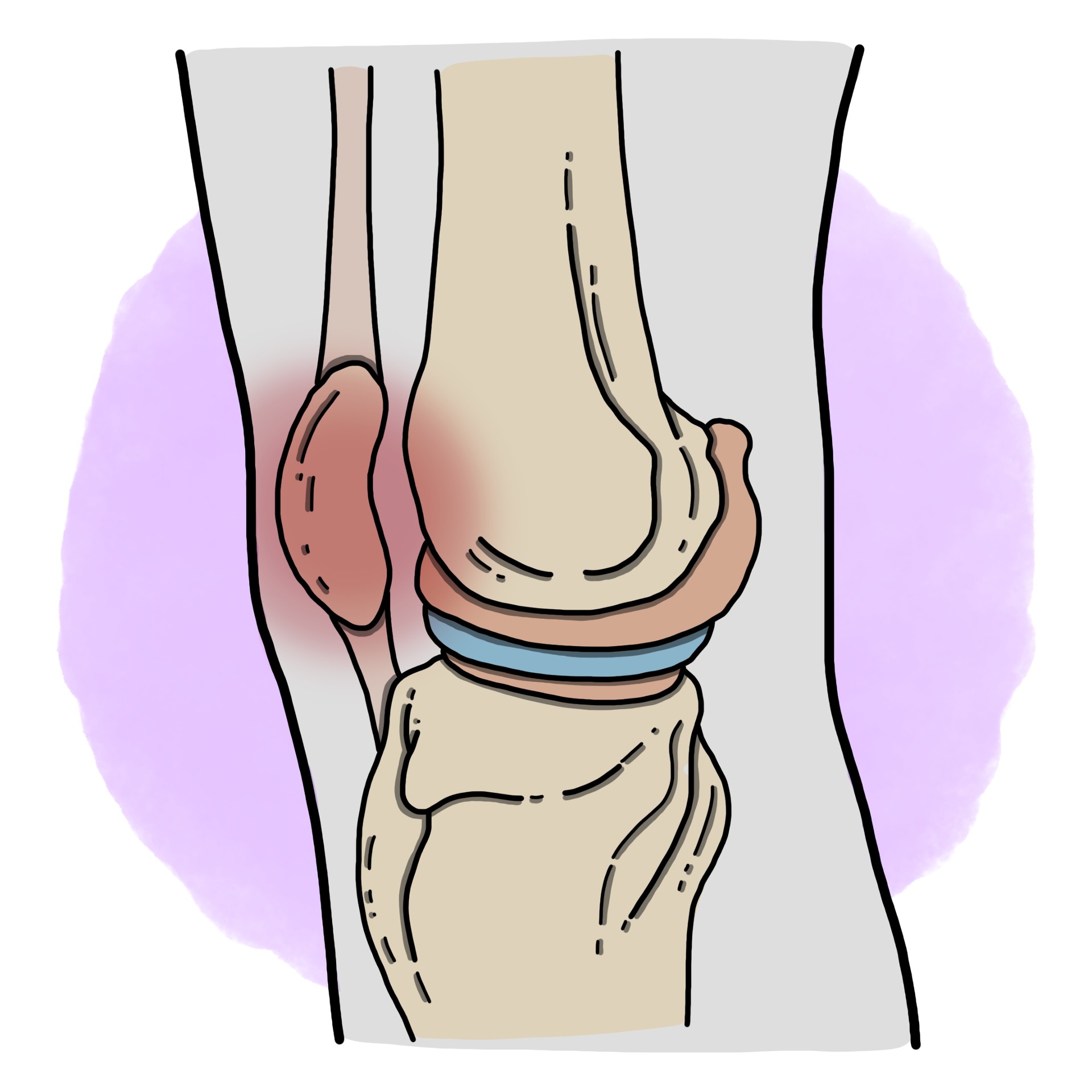 Chondromalacia patella