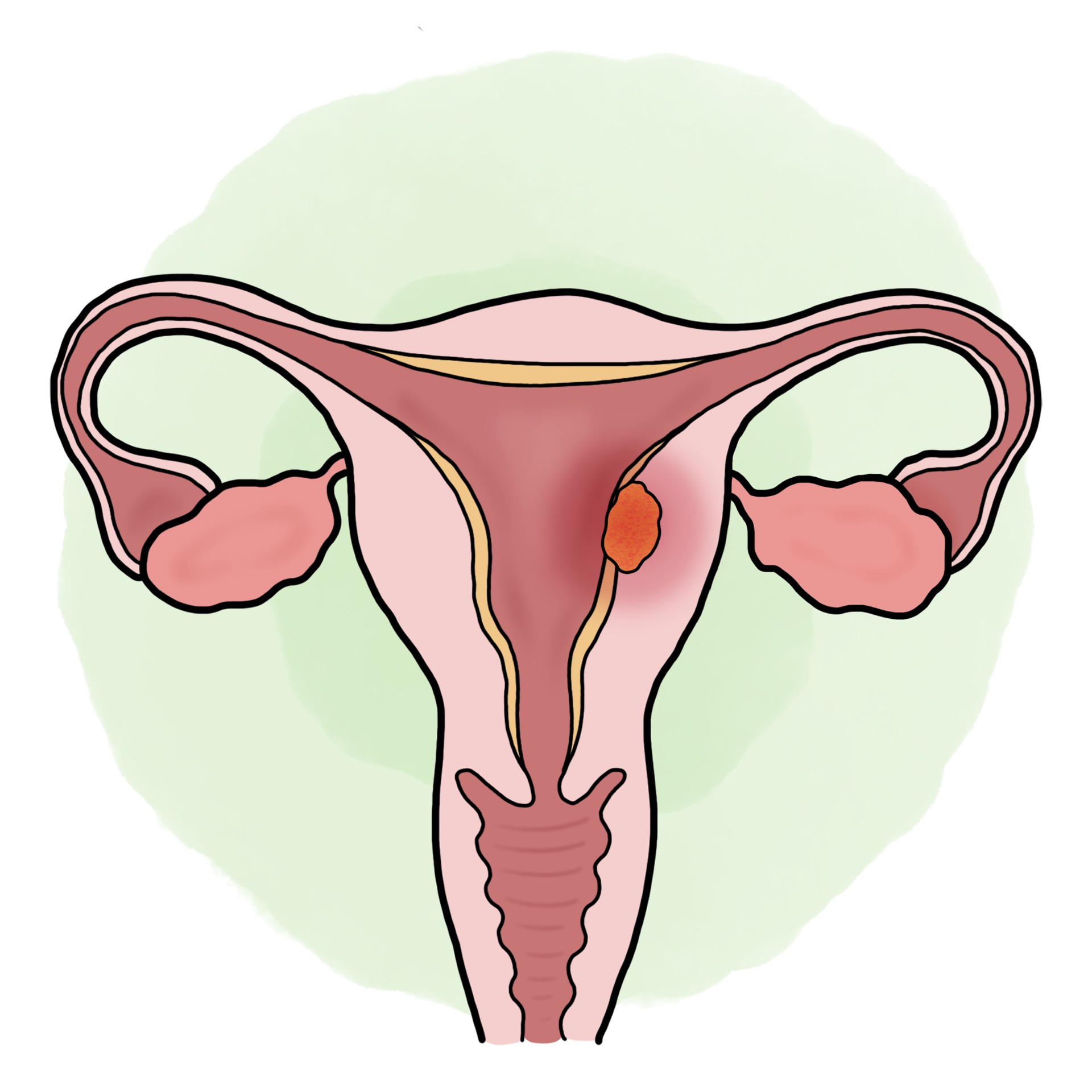 Uterus cancer - Endometrial cancer