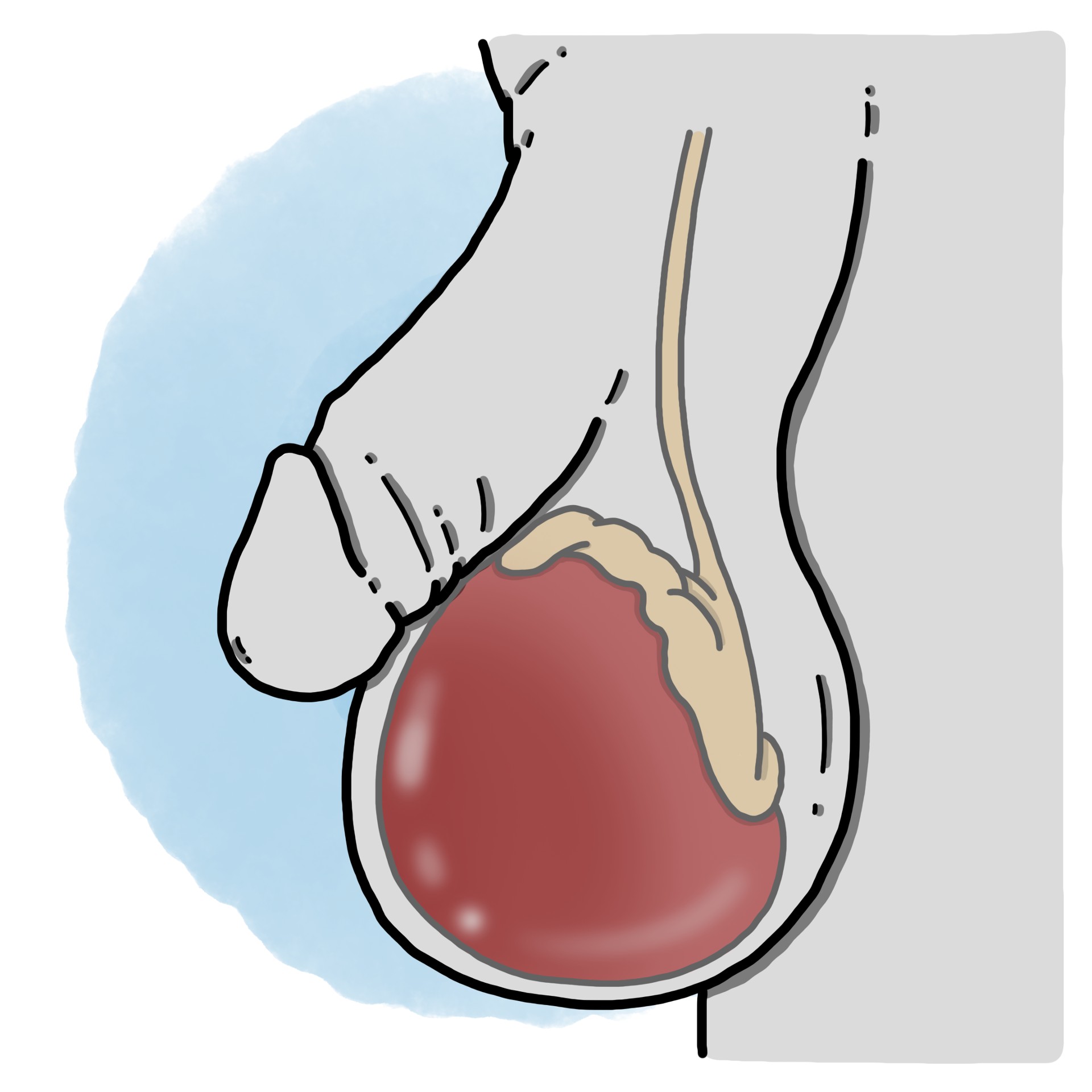 Epididymitis - Orchiepididymitis