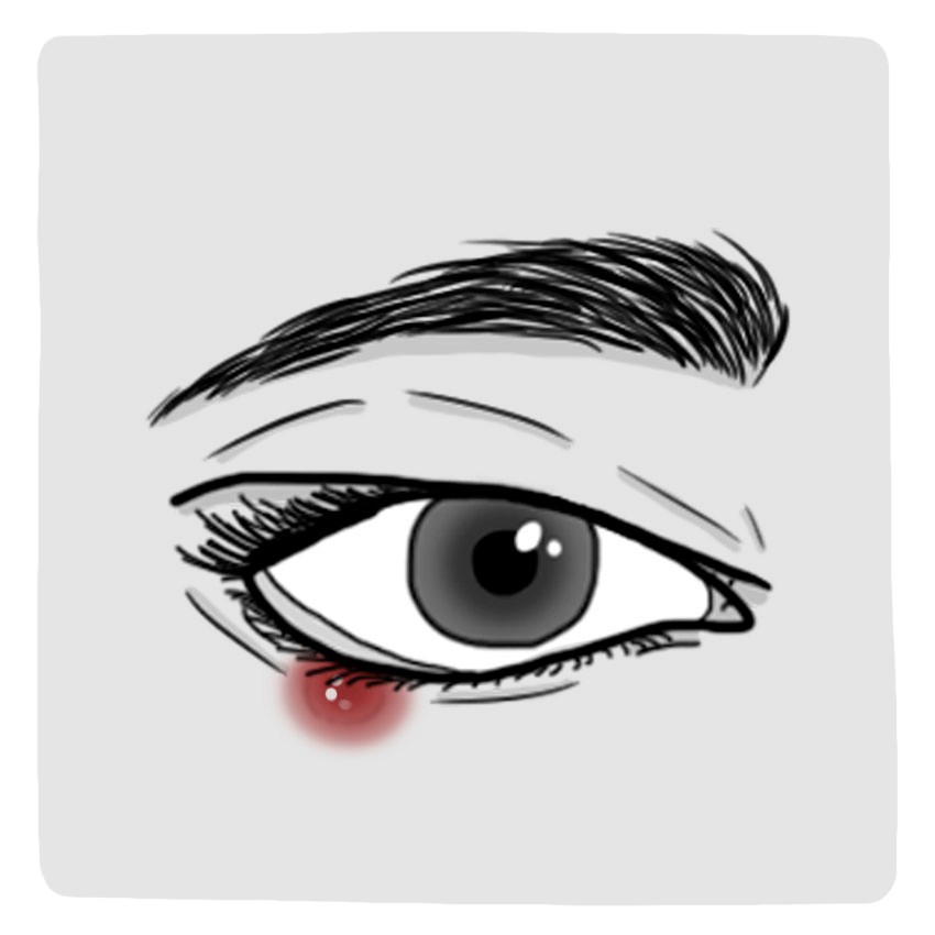 まぶたにある痛みを伴うしこり