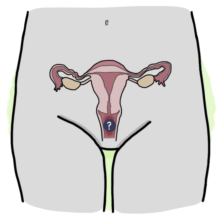 Foreign body in the vagina