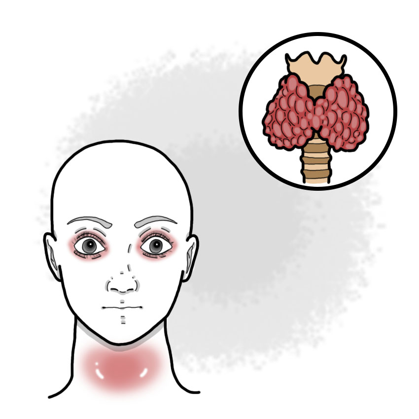 Hyperthyroidism - Graves' disease