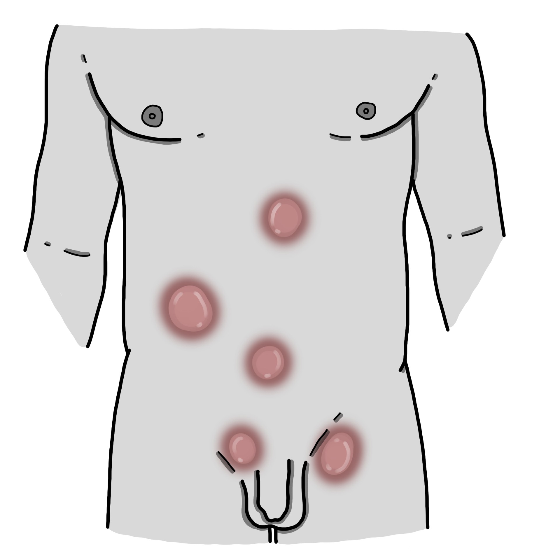 Uncomplicated abdominal hernia