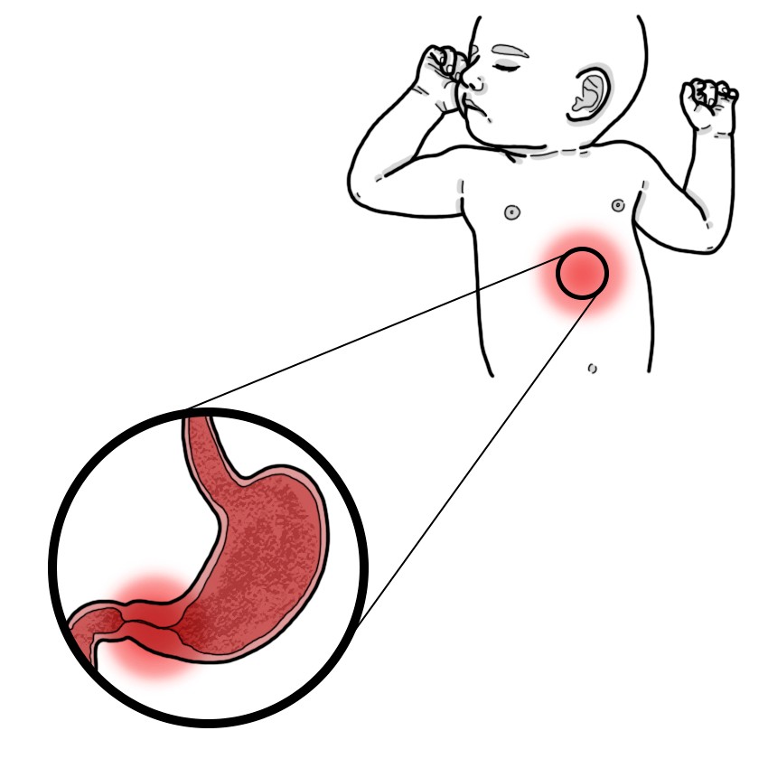 Hypertrophic pyloric stenosis (Paediatrics)