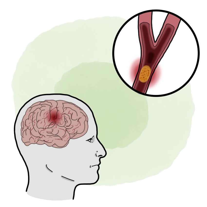 Transient ischaemic attack
