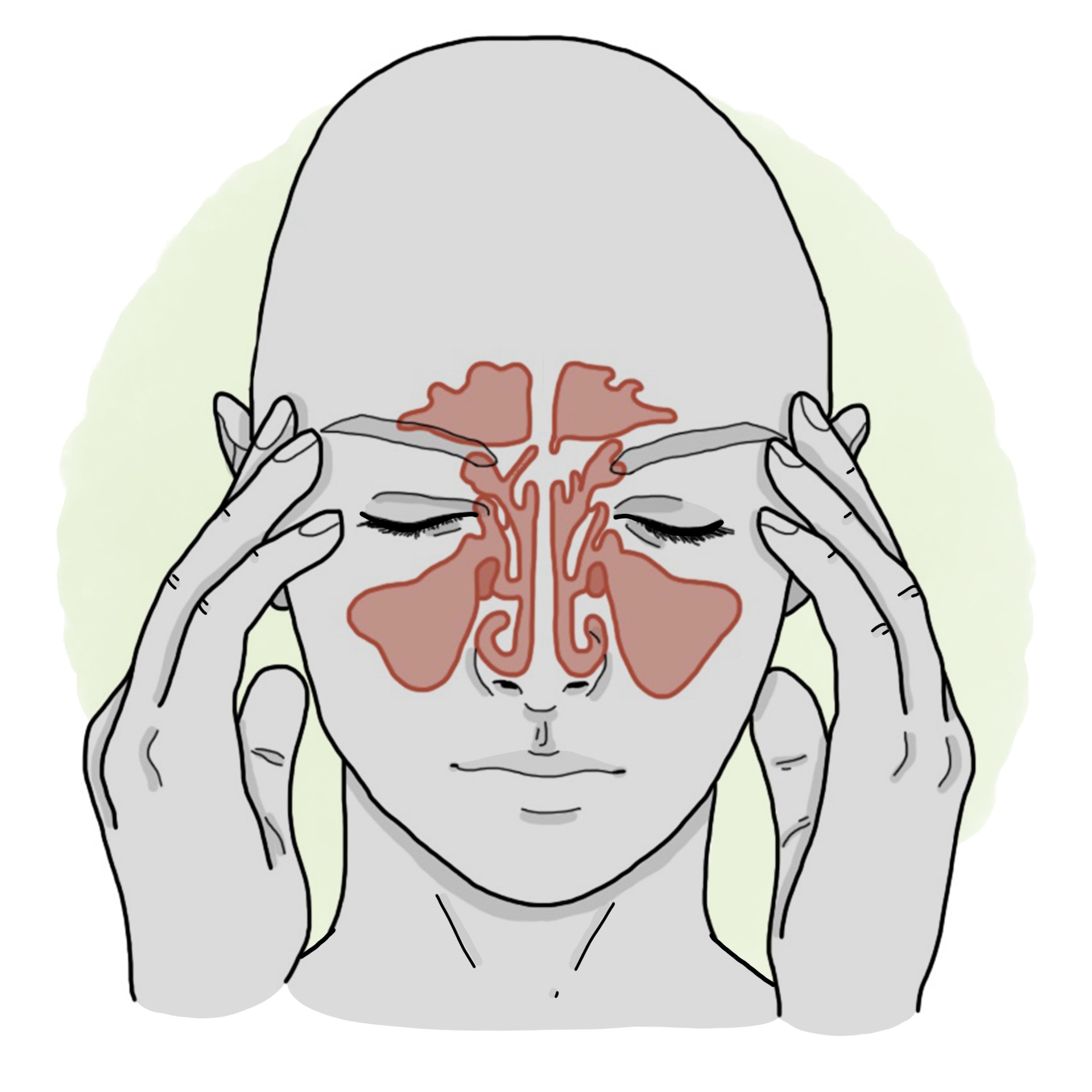 Sinusitis - Rhinosinusitis