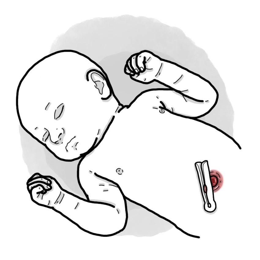 Omphalitis (Paediatrics)