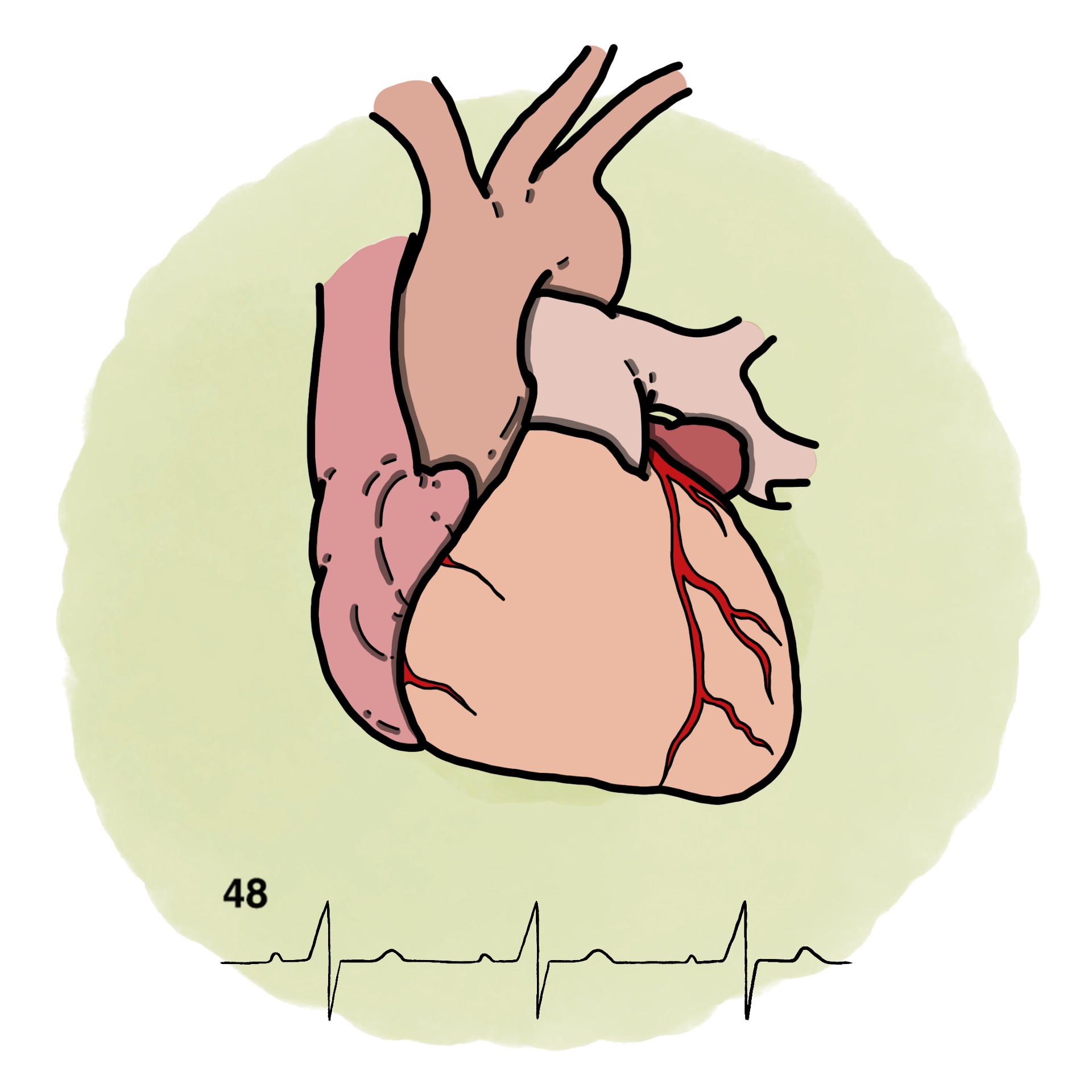 Sinus bradycardia (Paediatrics)