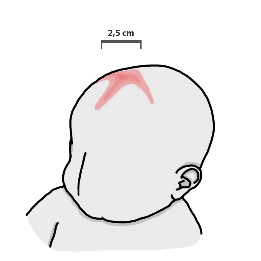 Defect in anterior fontanelle closure after 8 months of life