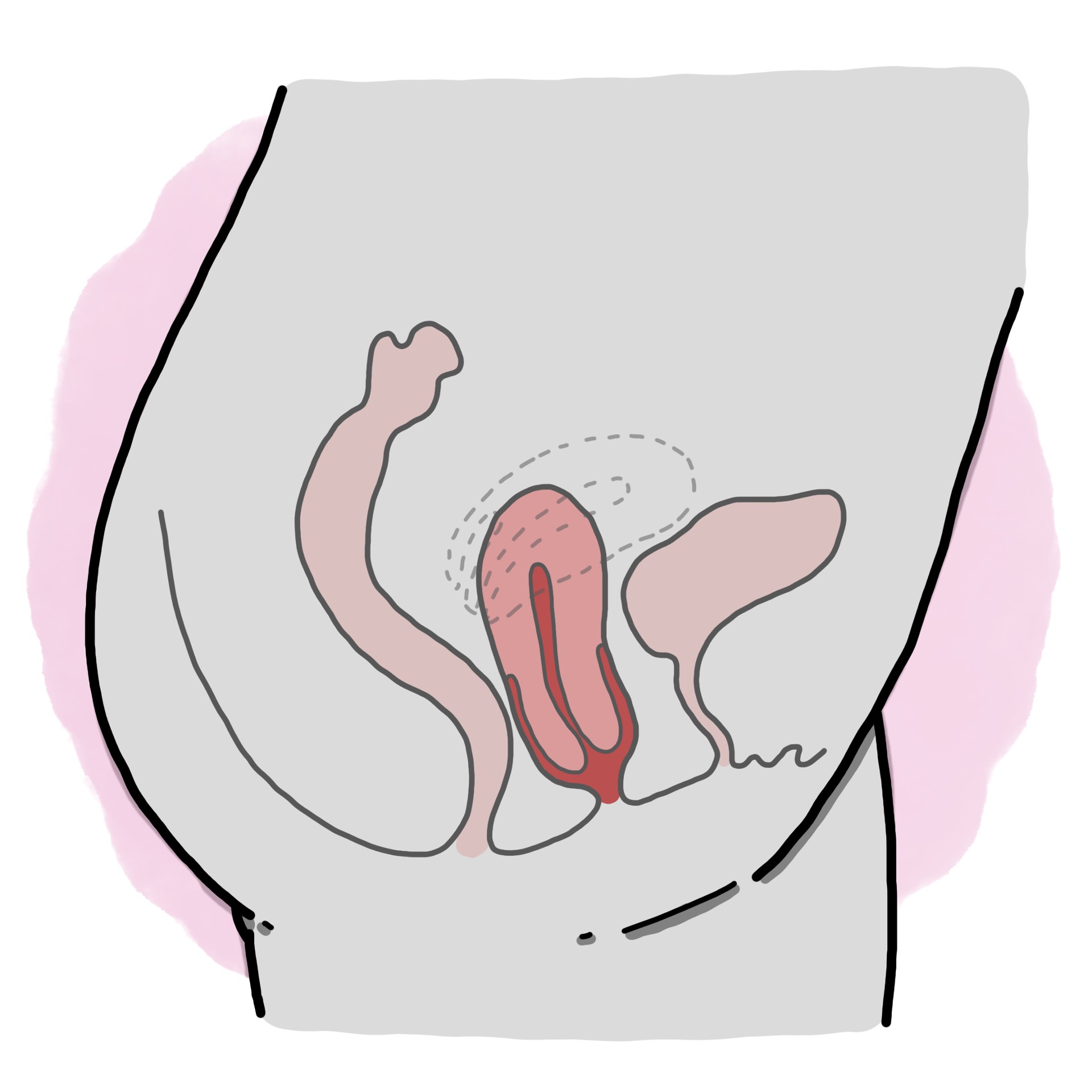 Uterine prolapse