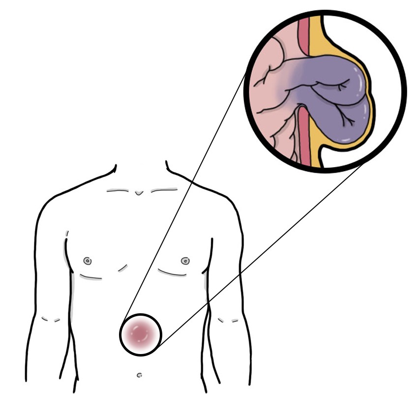 Strangulated abdominal hernia