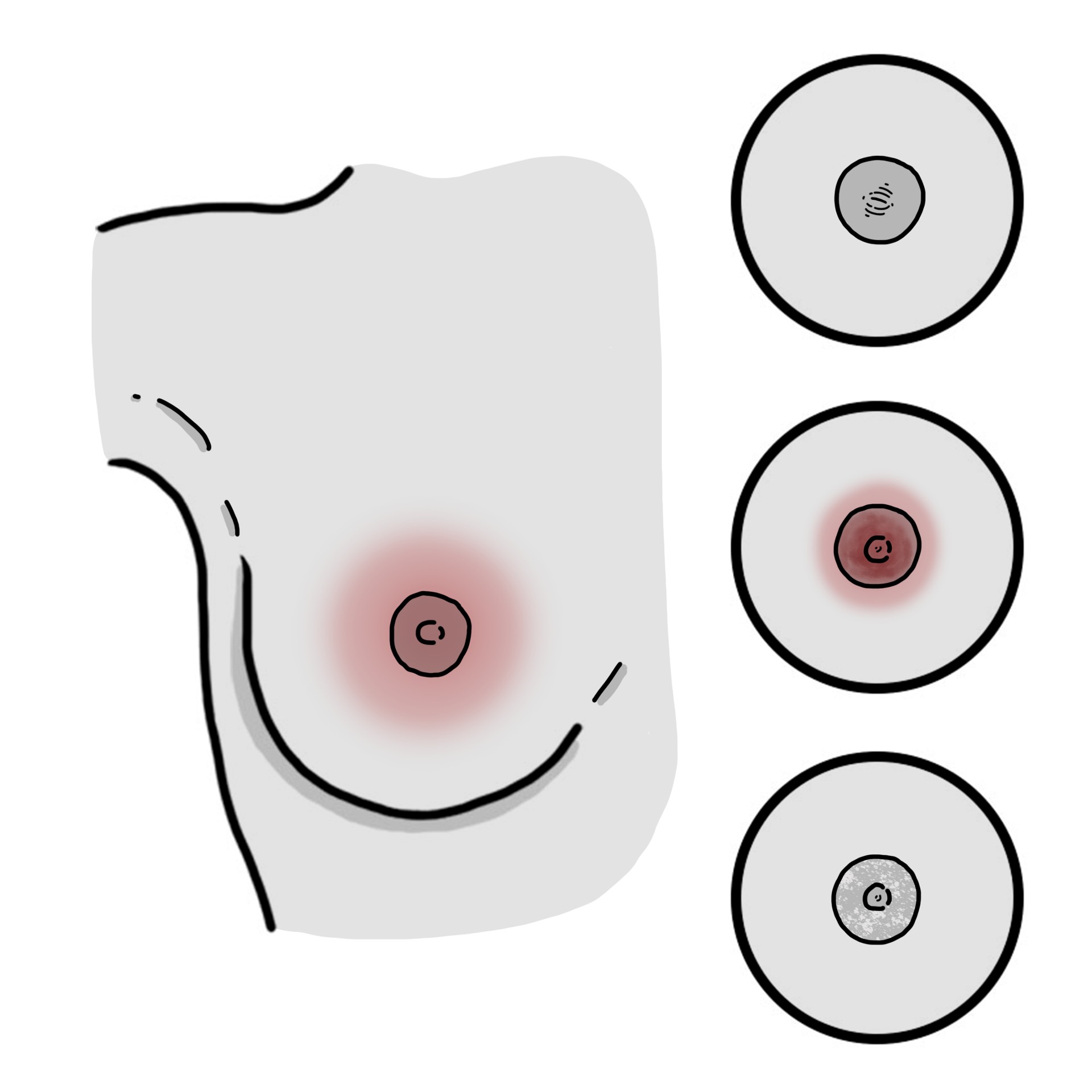 Retraction, erosion and/or flaking in the nipple