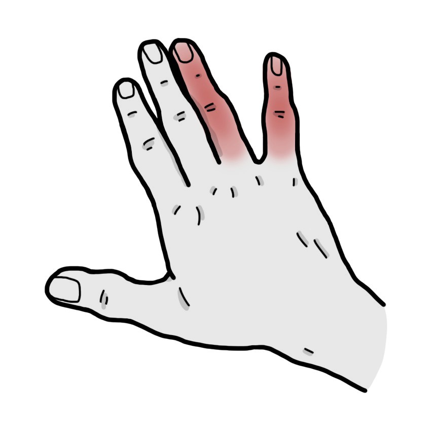 薬指と小指の痛み