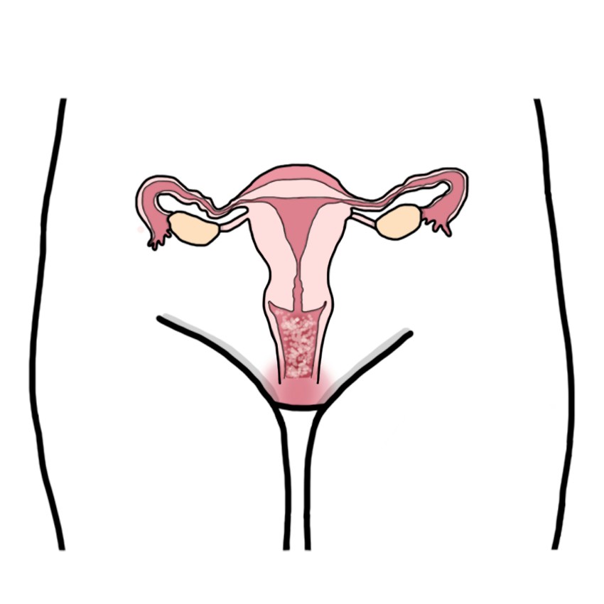 Fungal infection of the vagina - Candidal vulvovaginitis