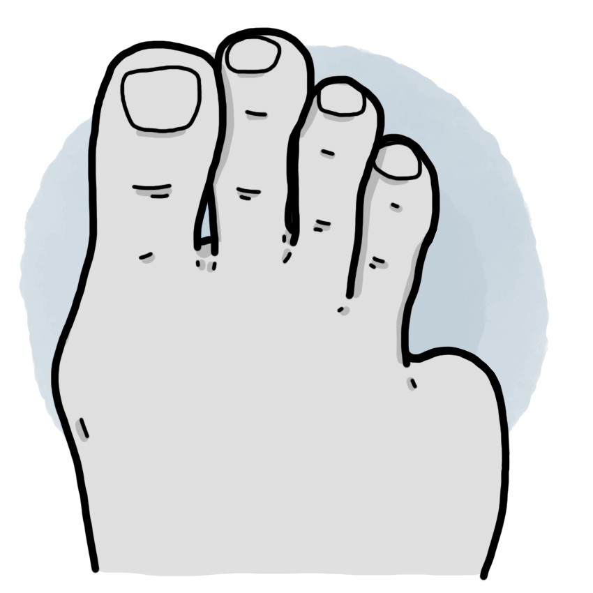 Fifth toe amputation