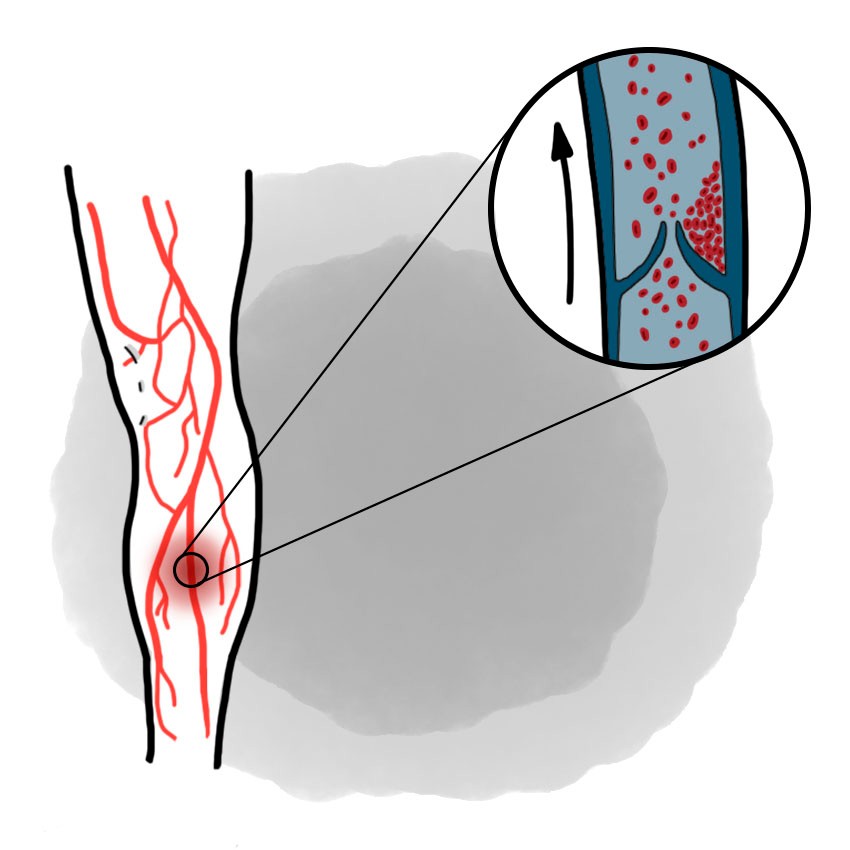 Acute arterial ischaemia due to thrombosis