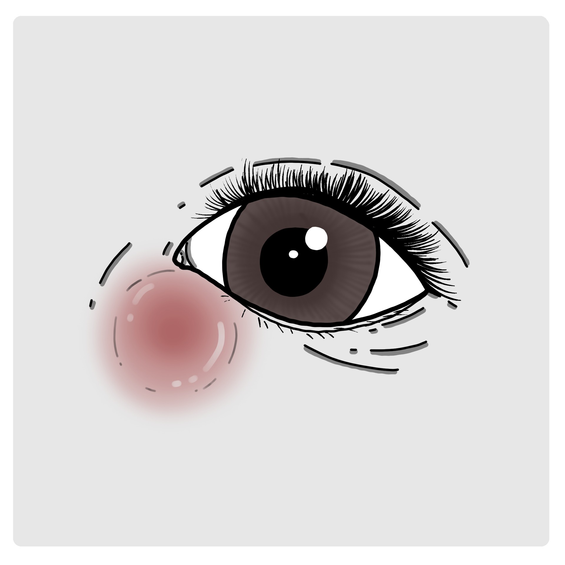 Lacrimal sac inflammation - Dacryocystitis