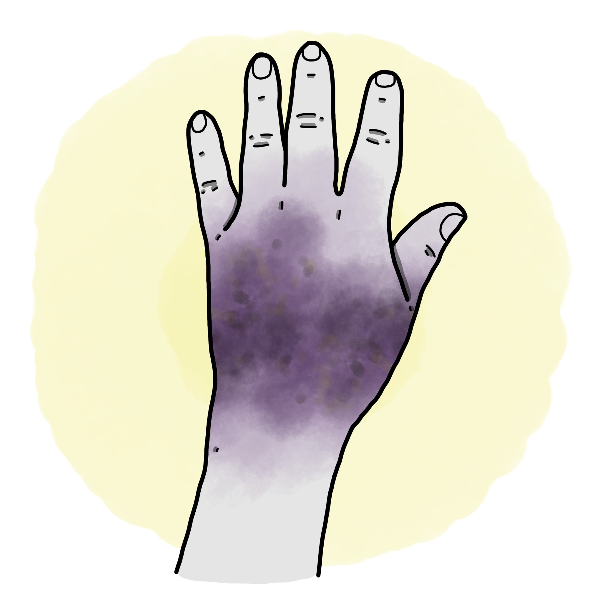 Hand trauma - Hand contusion